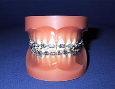 zahnspange-festsitzend